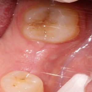 Dental Implants and Dentures