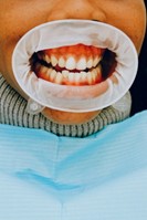 teeth with dental guard